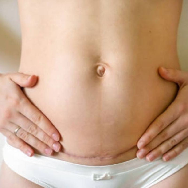 5+ điều kiêng cữ sau sinh mổ mà mẹ nhất định phải biết.