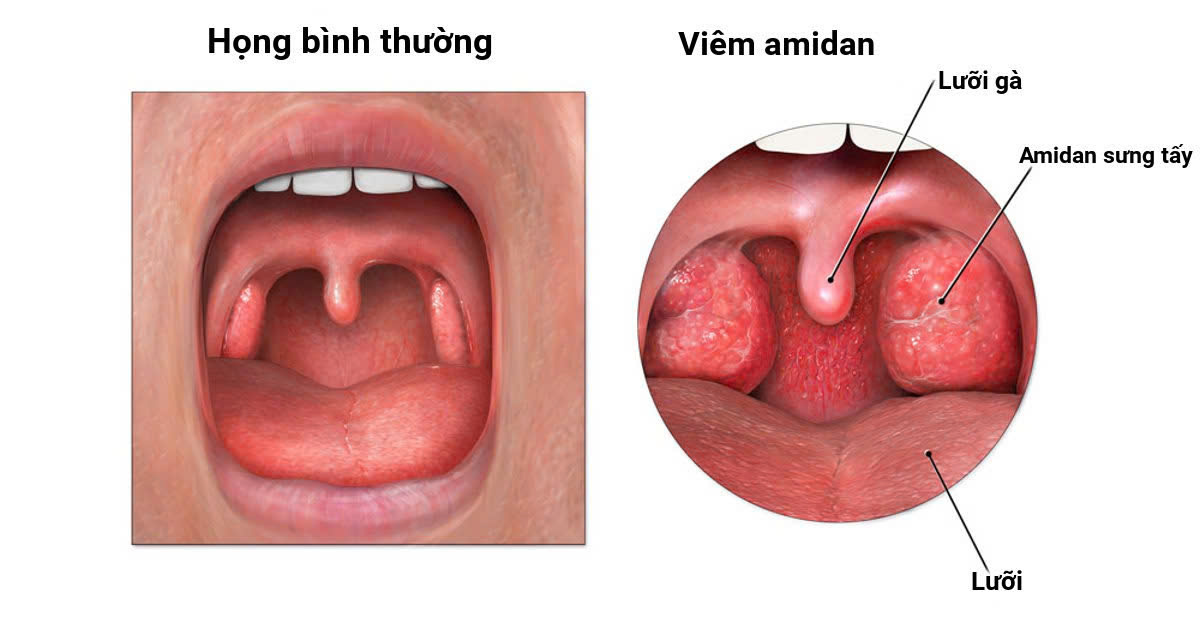 Bệnh viêm họng là gì?