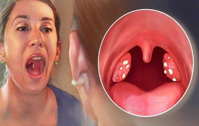 Cách điều trị bệnh viêm họng hạt