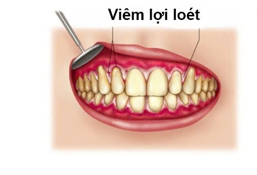 Nguyên nhân dẫn đến bị viêm loét lợi