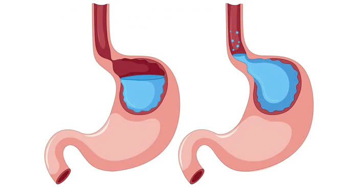 trào ngược dạ dày gây ho đờm