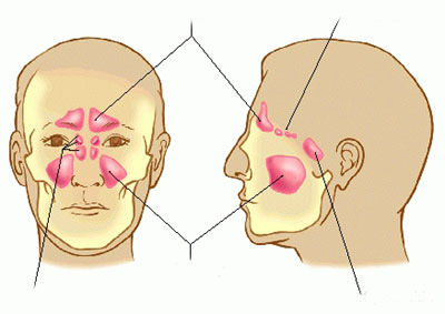 Viêm xoang hàm là bệnh gì?
