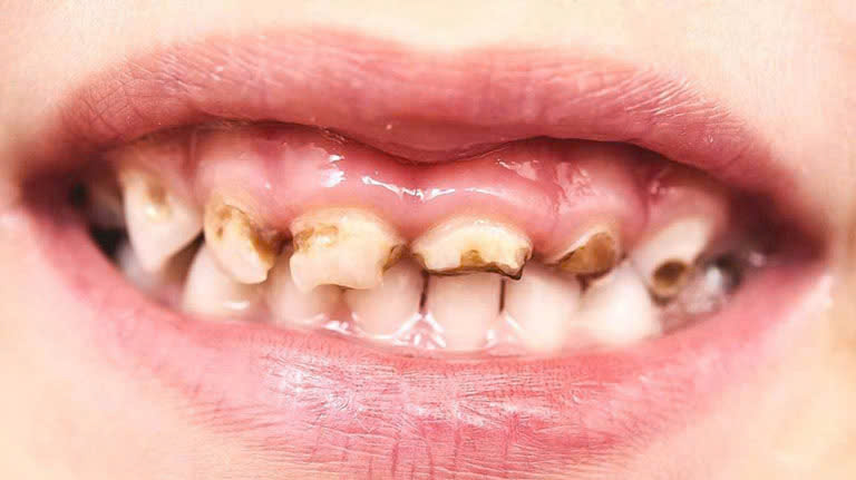 Dấu hiệu nhận biết sún răng ở trẻ nhỏ