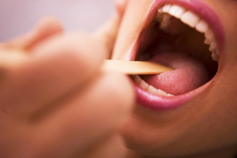 Triệu chứng viêm họng mạn tính
