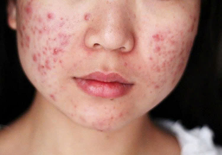 Chăm sóc da và sắc đẹp cho bà bầu bị mụn