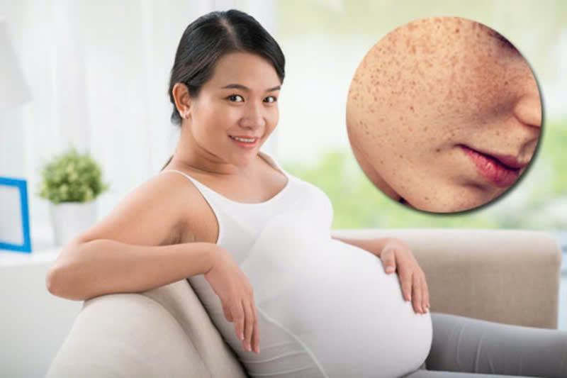 Chăm sóc da và sắc đẹp cho bà bầu bị nám
