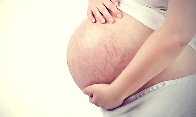 Chăm sóc da và sắc đẹp cho bà bầu bị rạn da