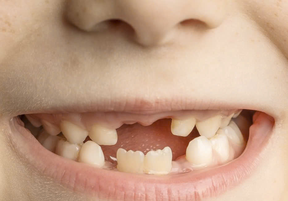 Nhổ răng sữa bị sún cho bé có được không?