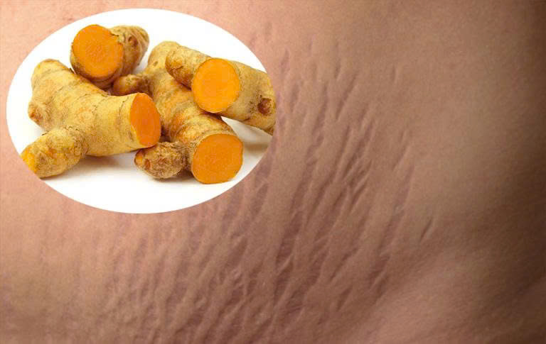 Lý do nên trị rạn da sau sinh bằng nghệ tươi