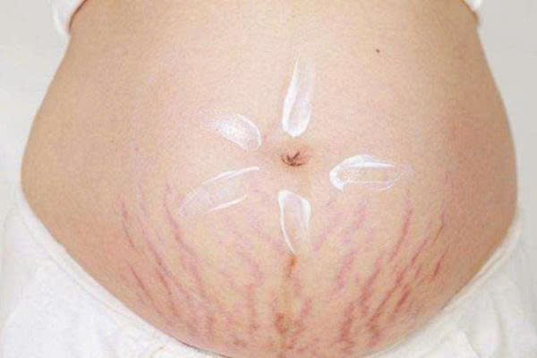 Vết rạn đỏ sau sinh có hết không?