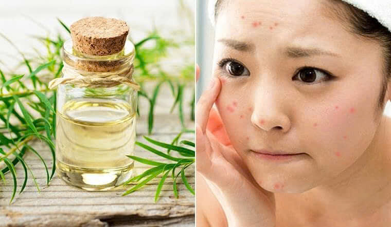Trị mụn cùng tinh dầu tràm trà hay Benzoyl Peroxide hiệu quả hơn?